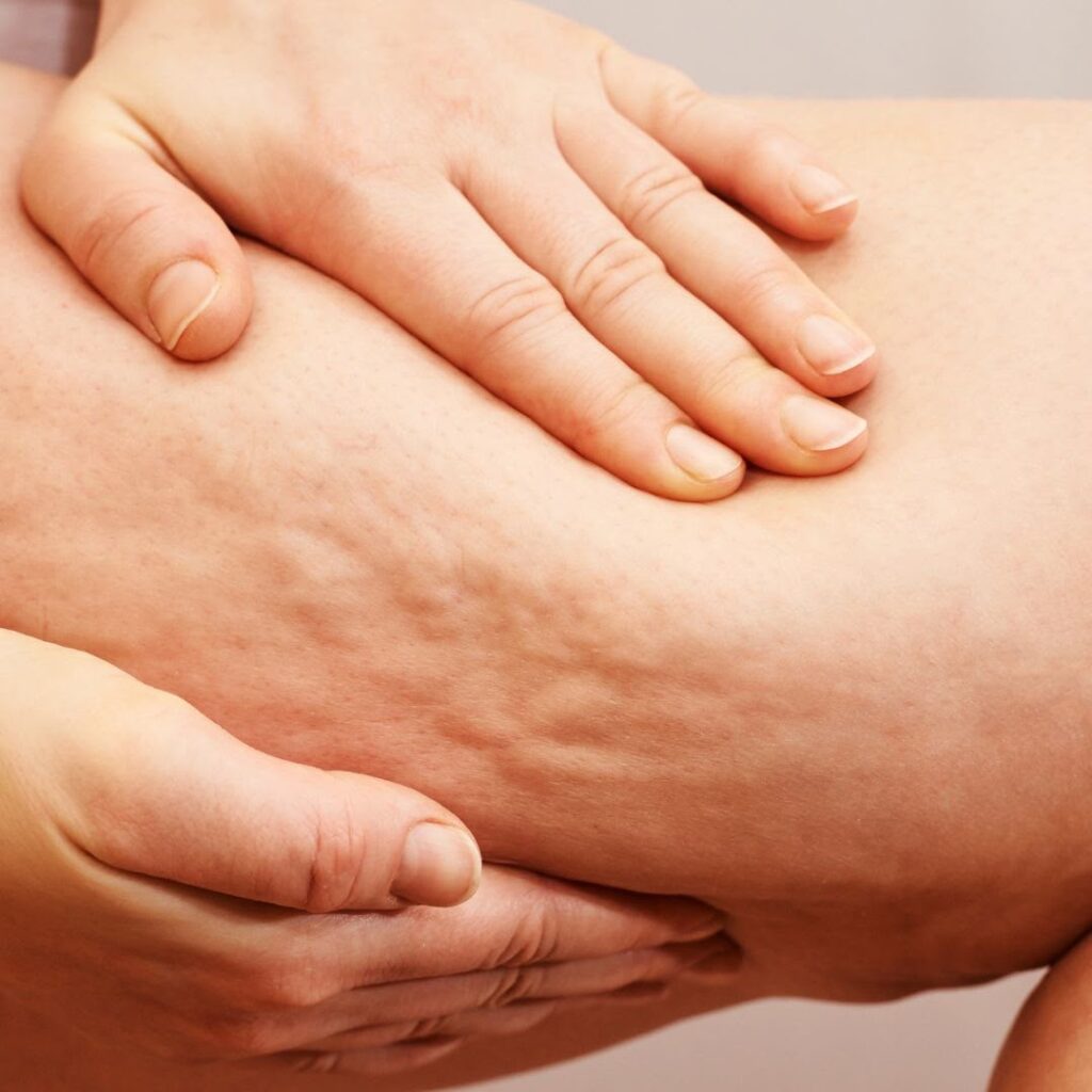 Inicio celulitis