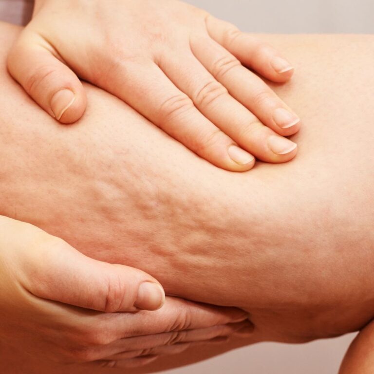 Tratamientos Corporales celulitis