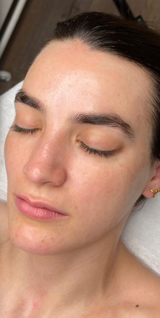 Tratamientos Faciales facial irene 2