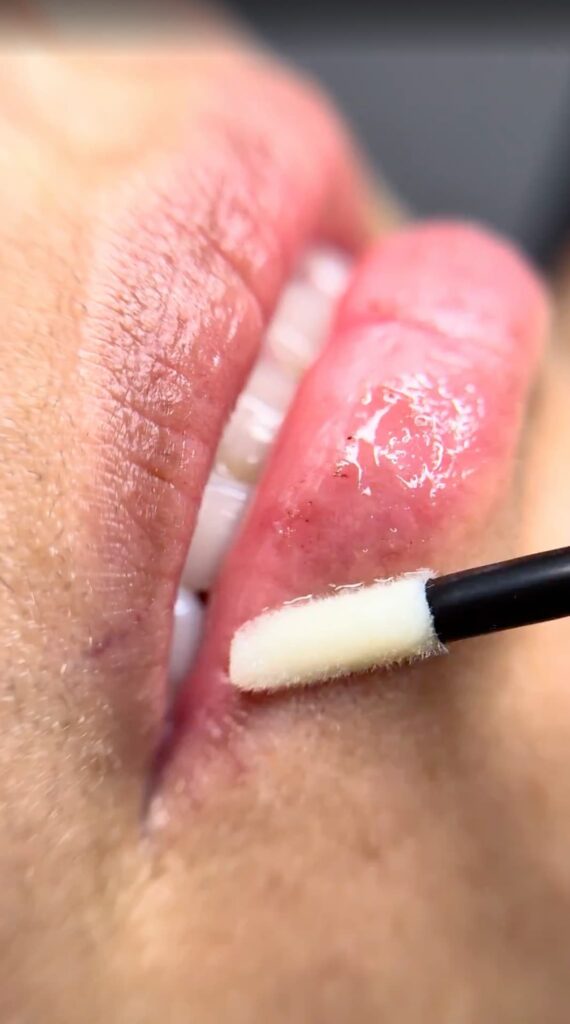 Tratamientos Faciales hidratación labia