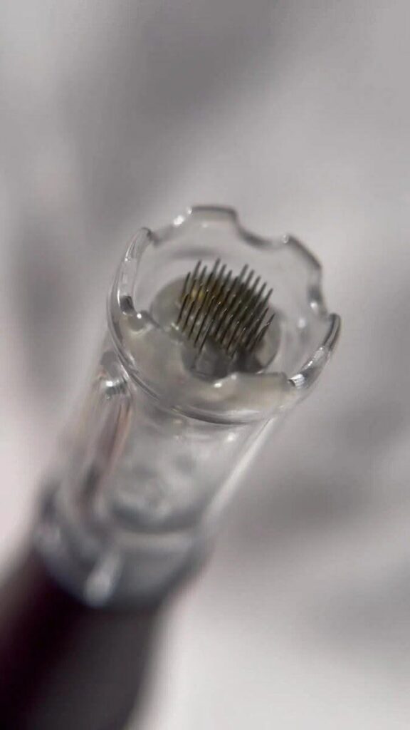 microneedling