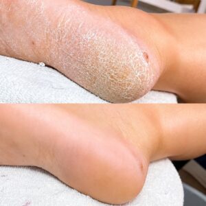 Inicio pedi antes y despues