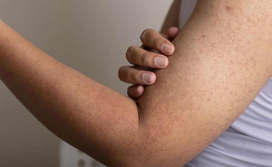 queratosis pilaris