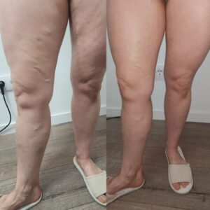 Inicio resultado corporal