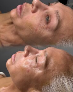 Inicio resultado facial