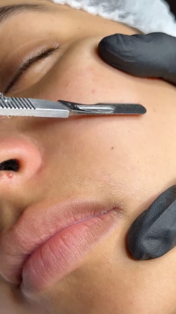 dermaplaning