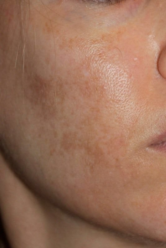 melasma